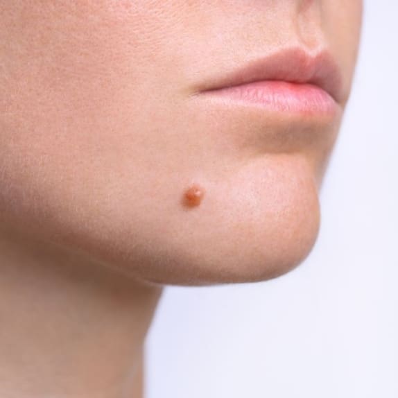 Wart Removal Surrey