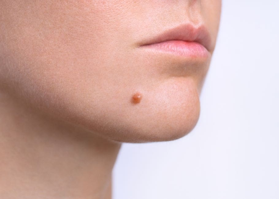 Wart Removal Surrey