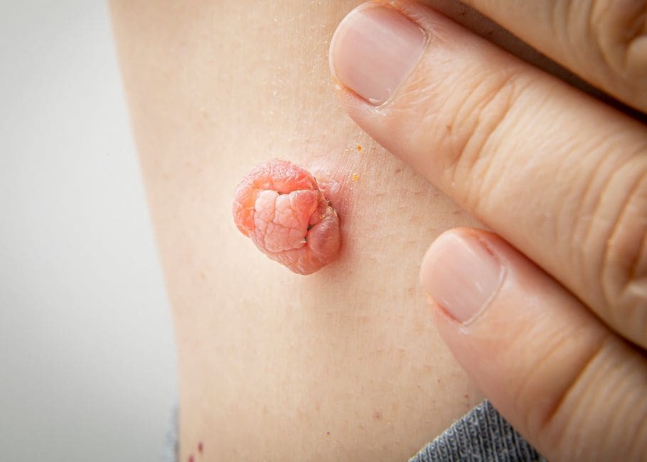 skin tag close on under armpit