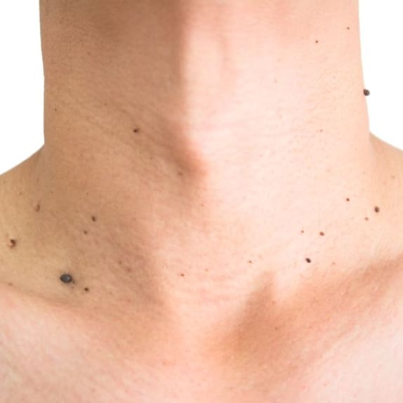 Skin Tag Removal Surrey