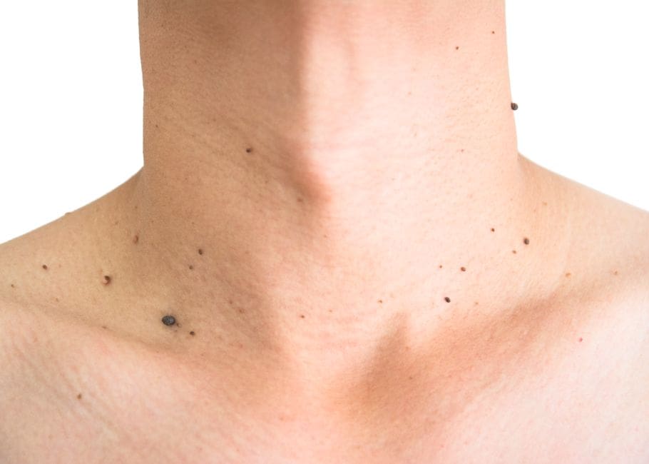 Skin Tag Removal Surrey