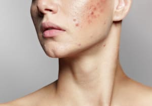 what is microneedling image