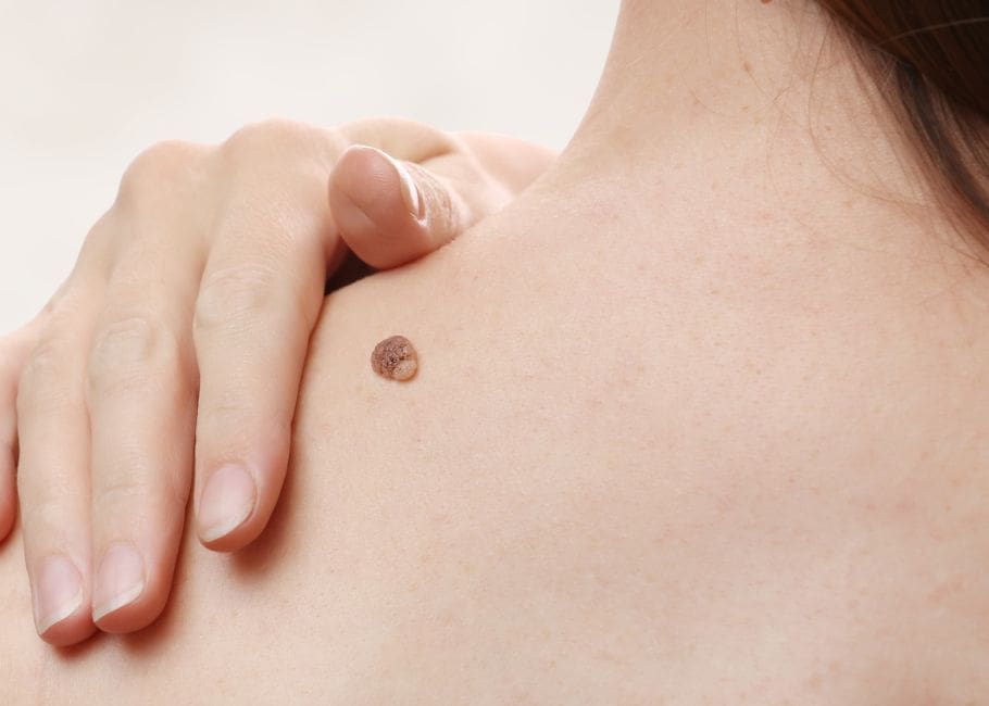 woman with large wart on her shoulder