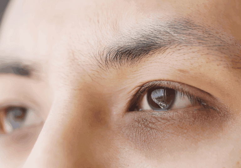 Polynucleotides Under Eyes: Do They Really Help Dark Circles and Hollows?