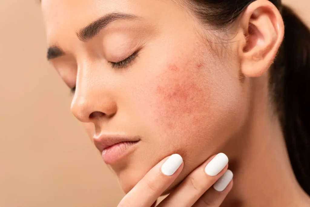 woman suffering with acne scars